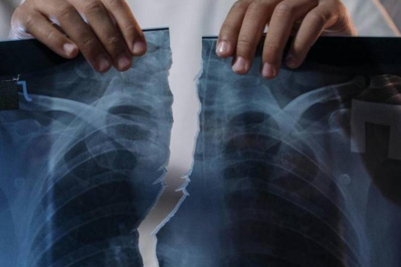doctor holding up a ripped x-ray image of someone's chest